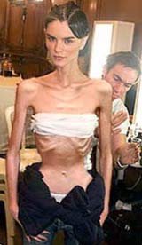 20070417141641-anorexia.jpg